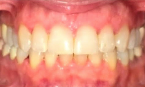 invisalign1