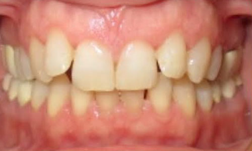invisalign2