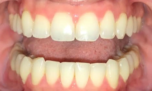 invisalign3